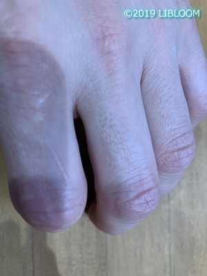 ケノンで指毛の効果は 指の隙間で反応しない やり方は Libloom